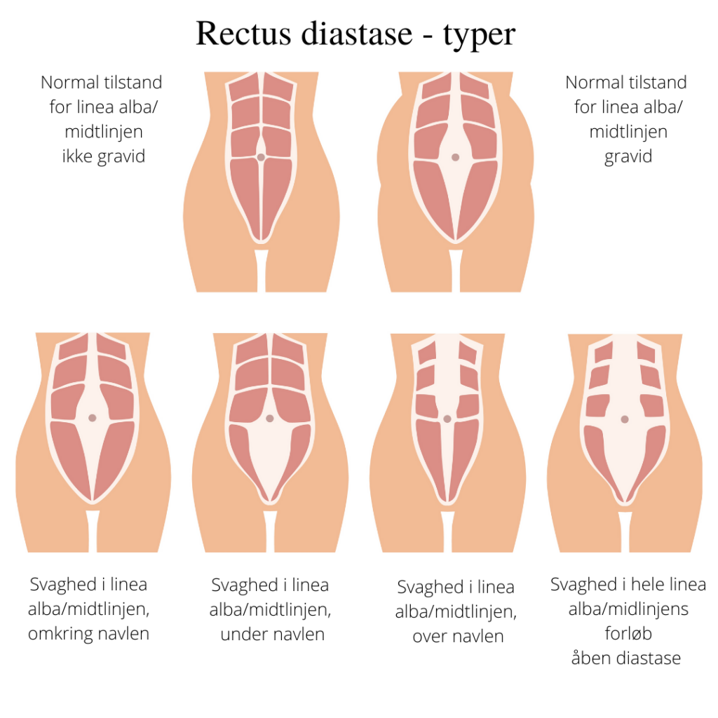 Typer af rectus diastase